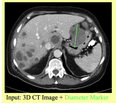 Axial CT image of the abdomen with a green diameter marker placed across a liver lesion.