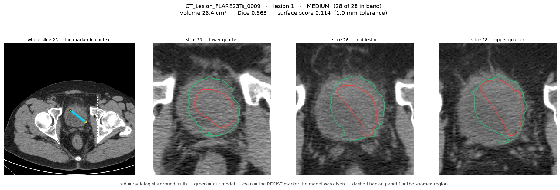 CT images of a medium lesion where the prediction covers a larger region than the reference annotation; the boundary is unclear, with DSC 0.563 and NSD 0.114.